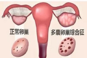 专家面临多囊卵巢长时间不排卵怎样促排更有用