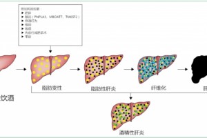 深度详解酒精相关性肝病的办理