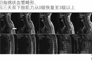 脊髓海绵状血管瘤手术治好病例——让患者用自己的双腿走下去