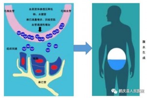 腹腔积液的CT确诊